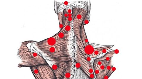 Triggerpunkte in den Muskeln, die myofasziale Rückenschmerzen verursachen