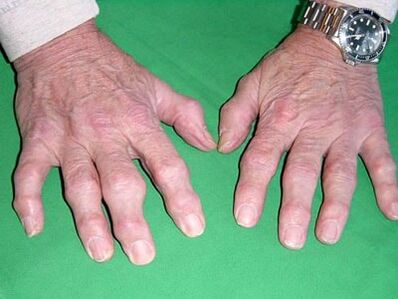Arthrose der Finger