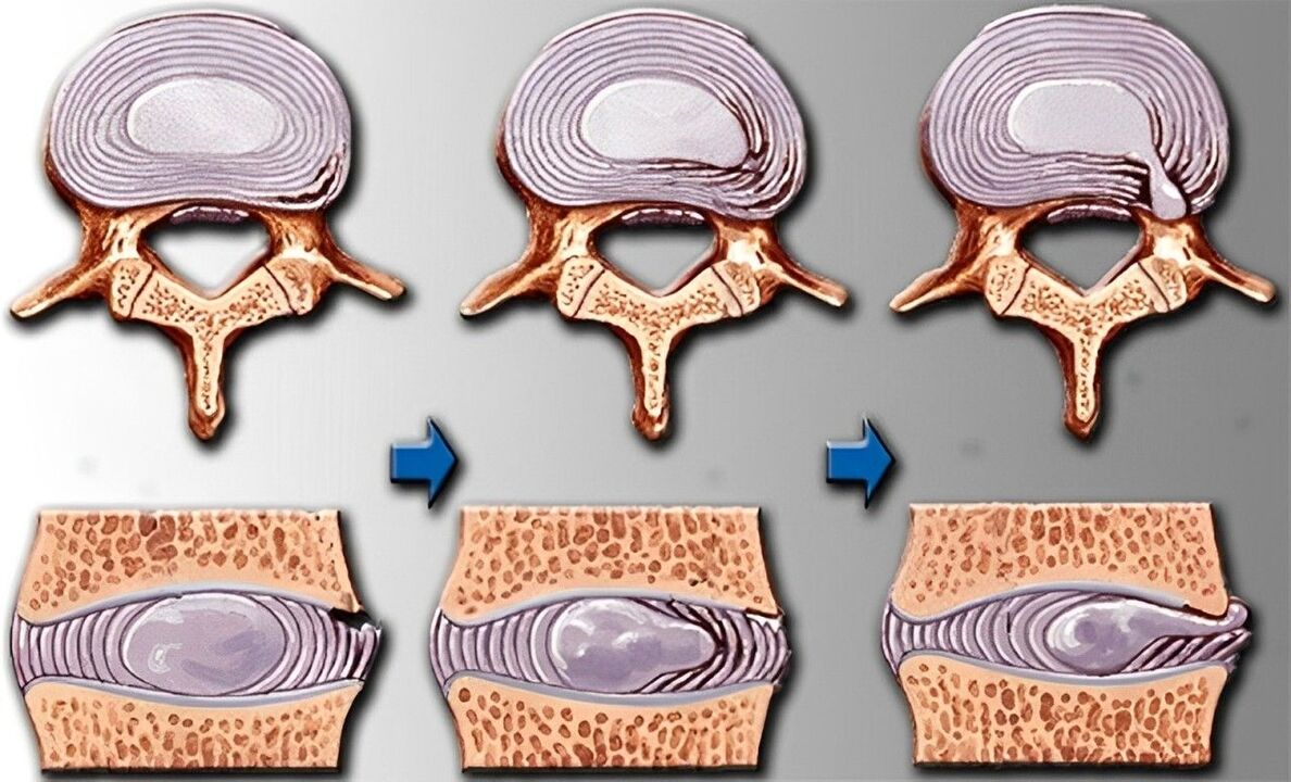 Stadien der Osteochondrose